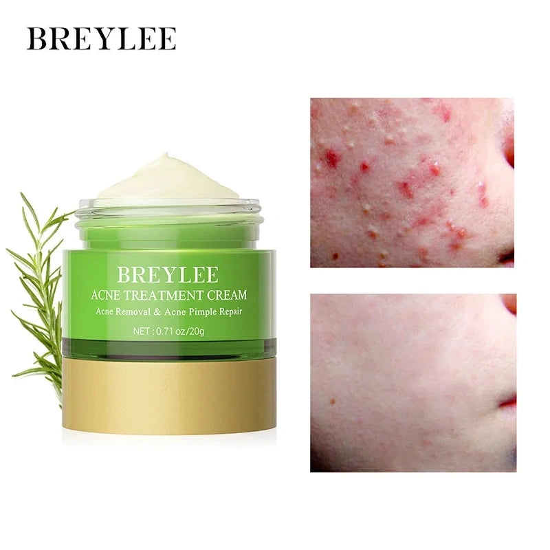 Breylee Tea Tree Acne 4-piece set series
